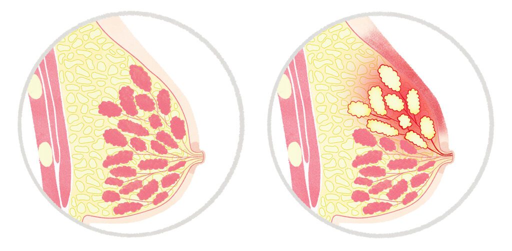 Normal breast versus mastitis comparison, with redness on the affected breast