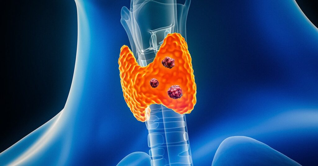 Visuel 3D de l'anatomie thyroïdienne, montrant des nodules thyroïdiens cancéreux.