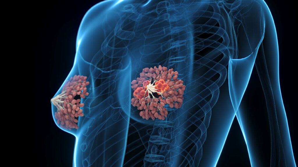 Detailed 3D render of breast lumps in a human female shown in full anatomical view.