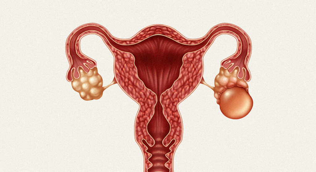 Uterine anatomy showing ovaries with cysts.